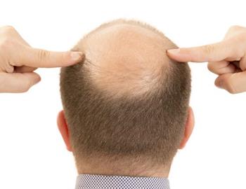 Combatir el problema de la alopecia